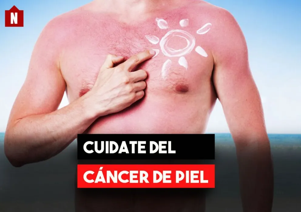 Prevención del cáncer de piel