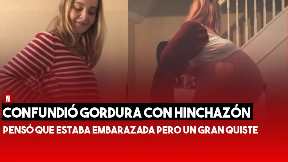 Pensaron que estaba embarazada pero era un quiste gigante