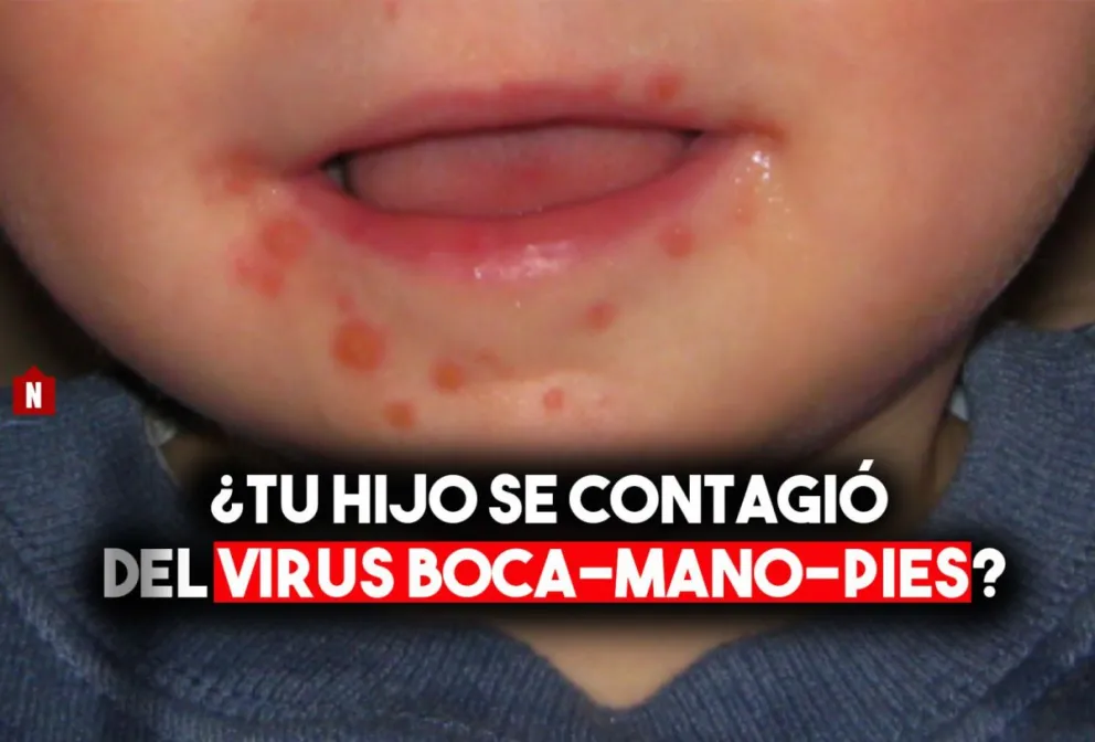 Detectan varios casos de menores con virus mano, boca y pies