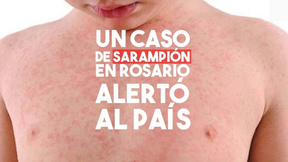 Un caso de sarampión alertó al país