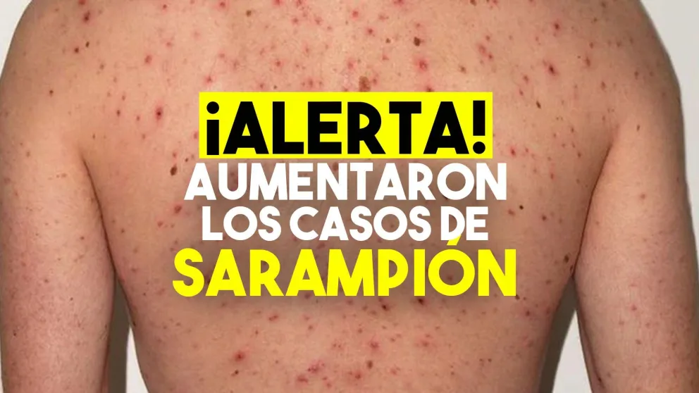 En lo que va de 2019, aumentaron 300% los casos de sarampión en el mundo