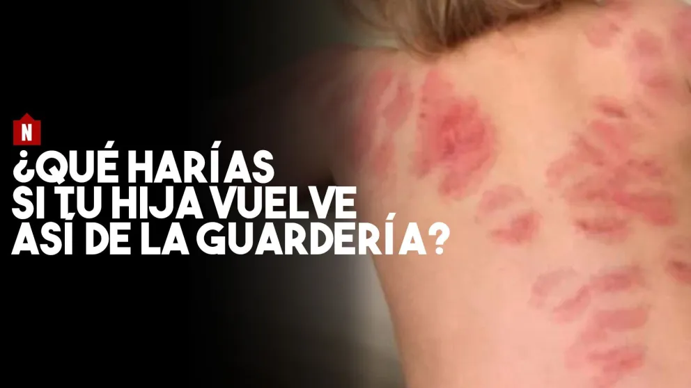 Mordida por todos lados: así le entregaron a su hijita en una guardería