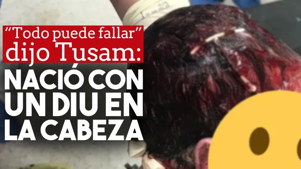 Un bebé nació con un DIU en la cabeza y su foto se viralizó