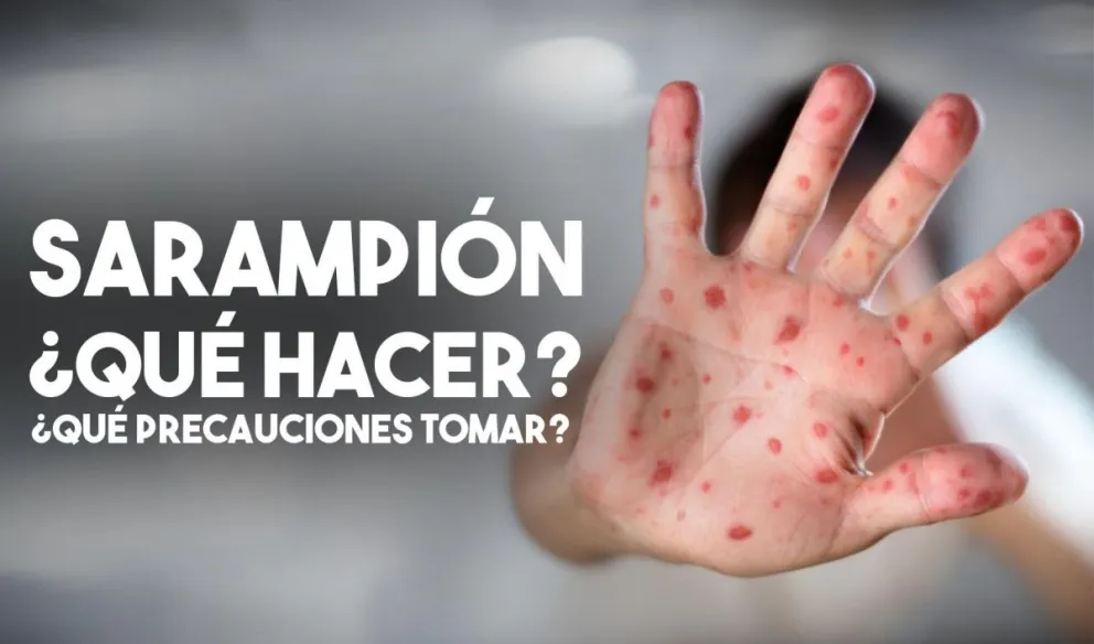 Advierten que la Argentina enfrenta un brote de sarampión