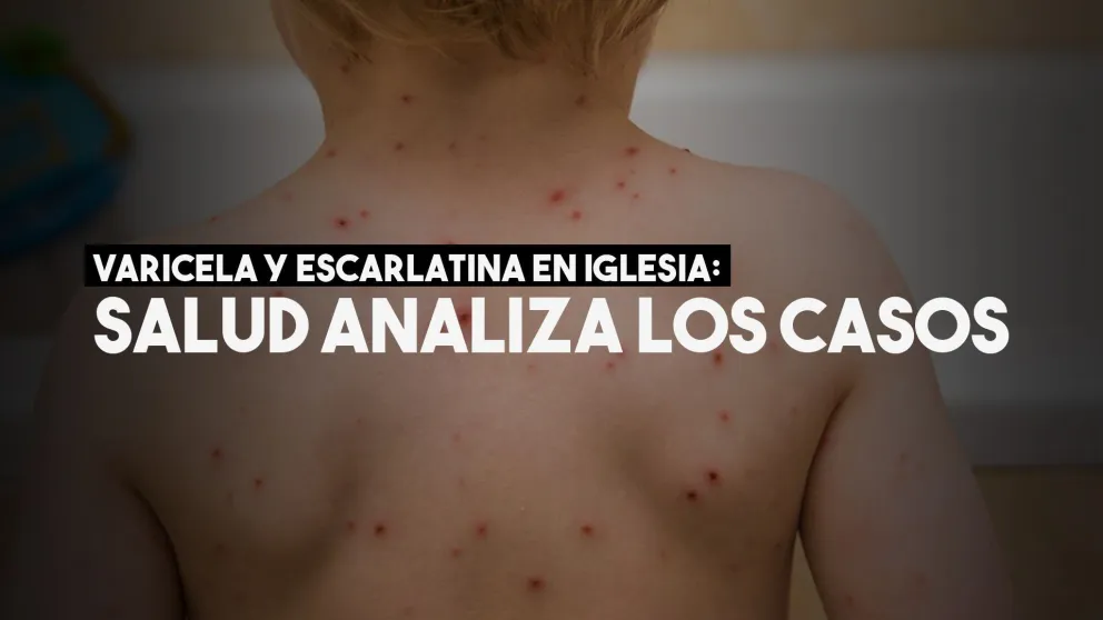 ¿Qué analiza Salud Pública en Iglesia ante los casos de varicela y escarlatina?