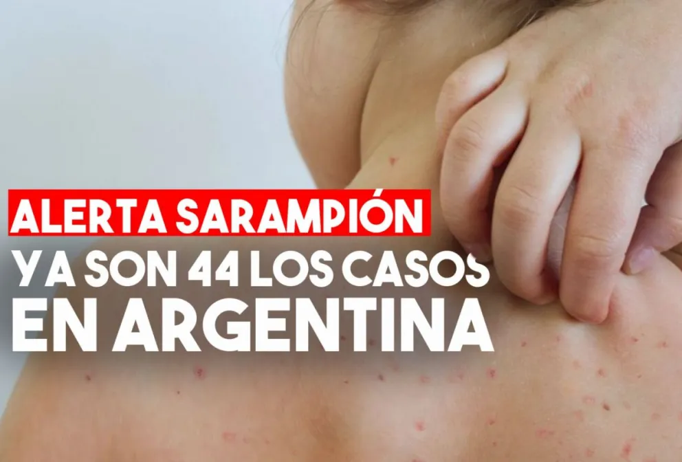 Ya son 44 las personas con sarampión en lo que va del año en la Argentina