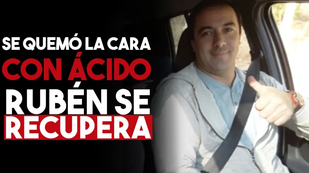 El hombre que se quemó la cara con ácido evoluciona favorablemente