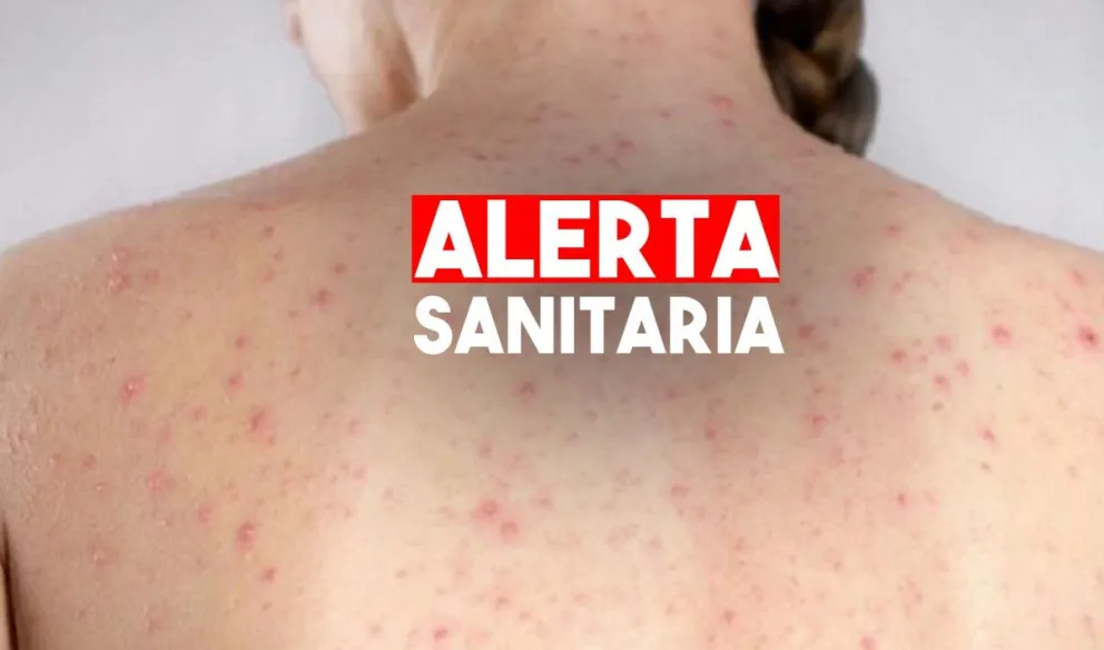 Una mujer y un hombre murieron en la Ciudad por sarampión y dengue