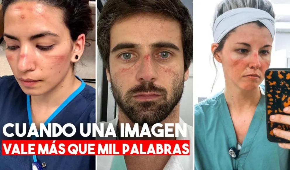 Coronavirus: ampollas y marcas en la nariz, los efectos de usar máscaras