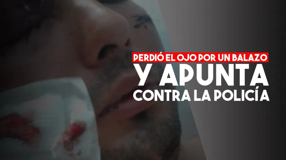 Perdió el ojo por un balazo y arremetió contra la Policía